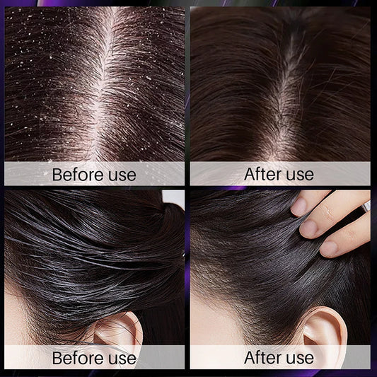 Hair Growth Thickening Shampoo Hair Growth Deep Cleansing Volumizing Shampoo Rosemary Onion Shampoo Hair Thickening Care Product