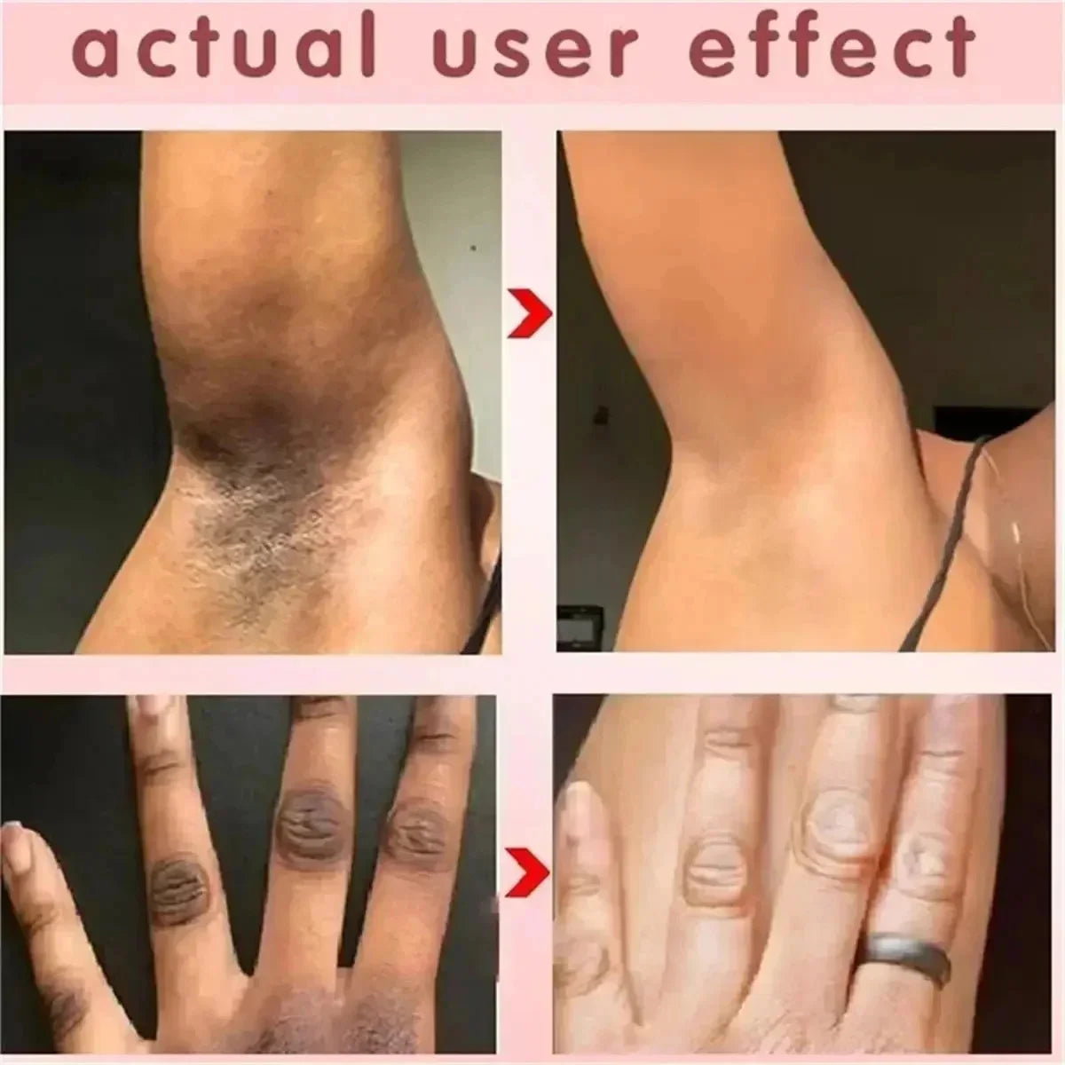 Whitening Body Cream For Dark Skin Armpit Thigh Inner Joint Fade Intimate Area Underarm Body Care Private Part Brighten Lotion