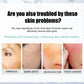 Freckle Whitening Cream Fade Dark Spot Blemish Acne Mark Remove Melanin Shrink Pores Lightening Pigmentation Correction Cream