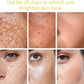 Powerful Dark Spots Remover Freckle Whitening Serum Melanin Correcting Anti Pigmentation Brighten Korean Day Night Facial Care
