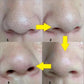 10/20/50PCS Nose Blackhead Remover Mask Shrink Pore Acne Treatment Sticker Black Dots Strips Nose Deep Cleansing Cleane