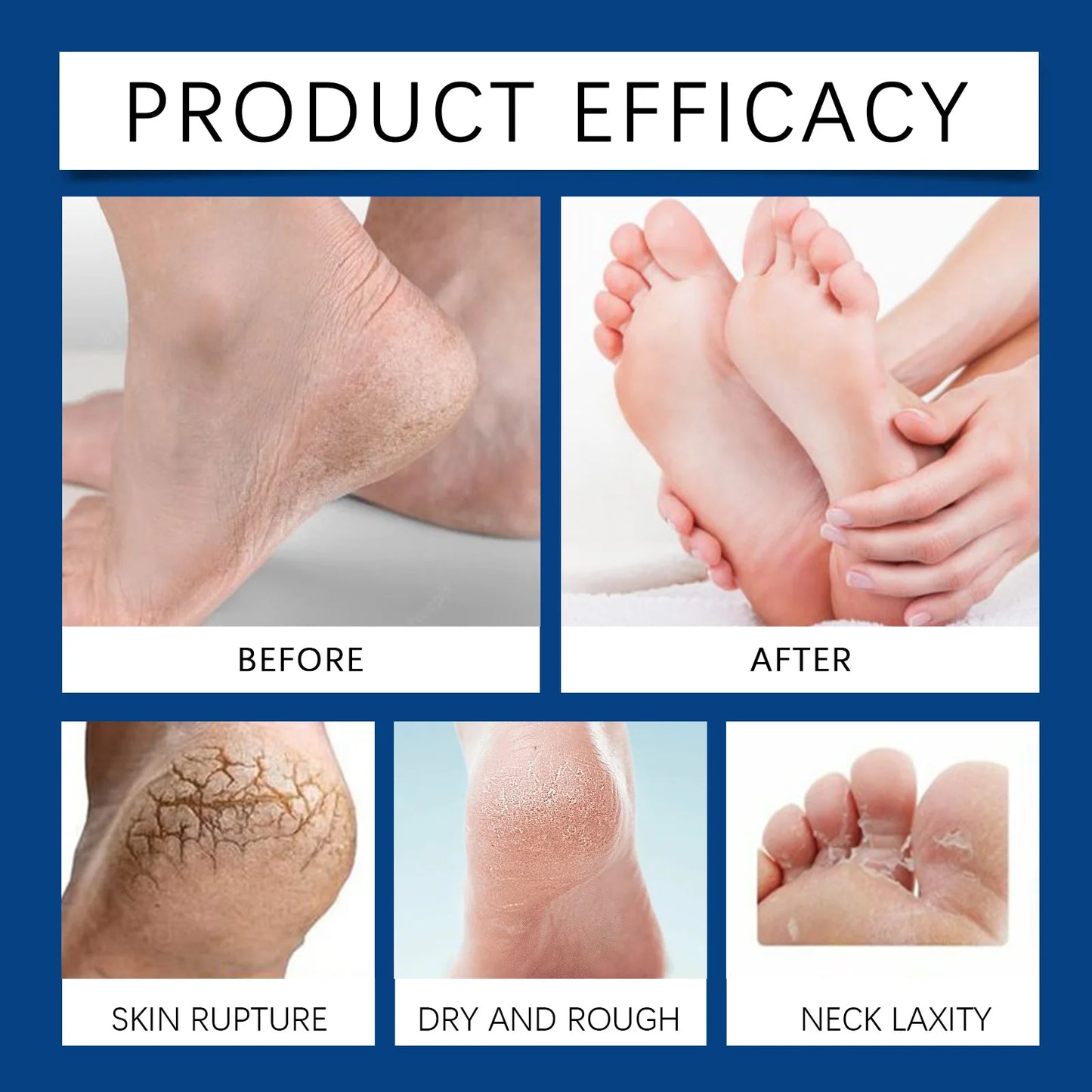 Foot Callus Remover Gel Hydrating Smooth Feet Skin Anti Drying Cracked Heel Repair Cream Soften Calluses Dead Skin Removal Gel