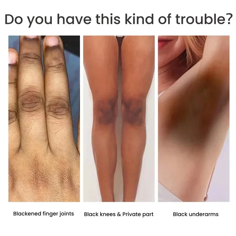 Body Whitening Bleach Cream Brighten Underarm Elbow Knees Joint Removal Intimate Parts Dark Spots Melanin Snow Bleach Cream