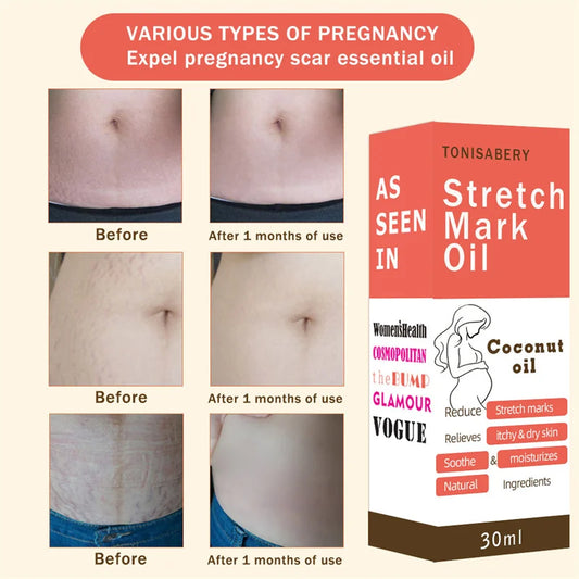Stretch Marks Remover Essential Oil Pregnancy Maternity Body New Old Stretch Mark Removal Serum Increase Elasticity of Skin