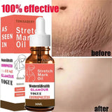 Stretch Marks Remover Essential Oil Pregnancy Maternity Body New Old Stretch Mark Removal Serum Increase Elasticity of Skin